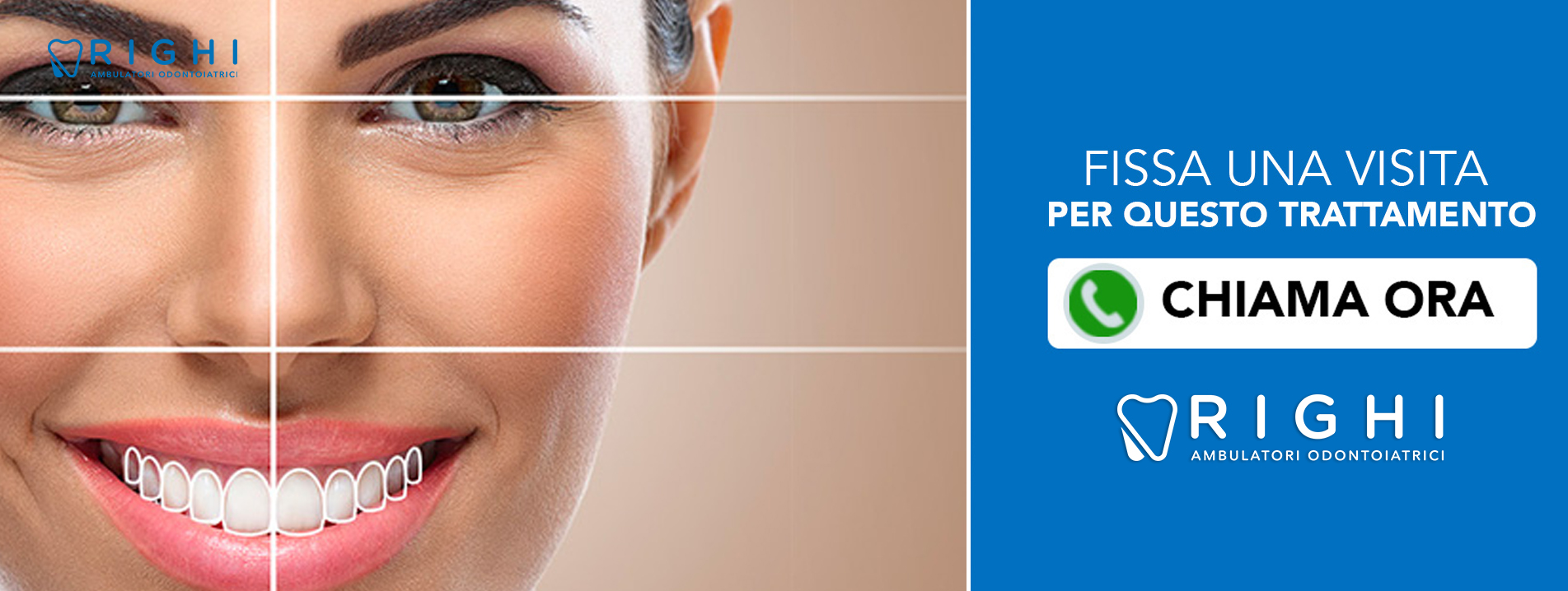 faccette-estetiche-dentista-Rivalta (Reggio Emilia)