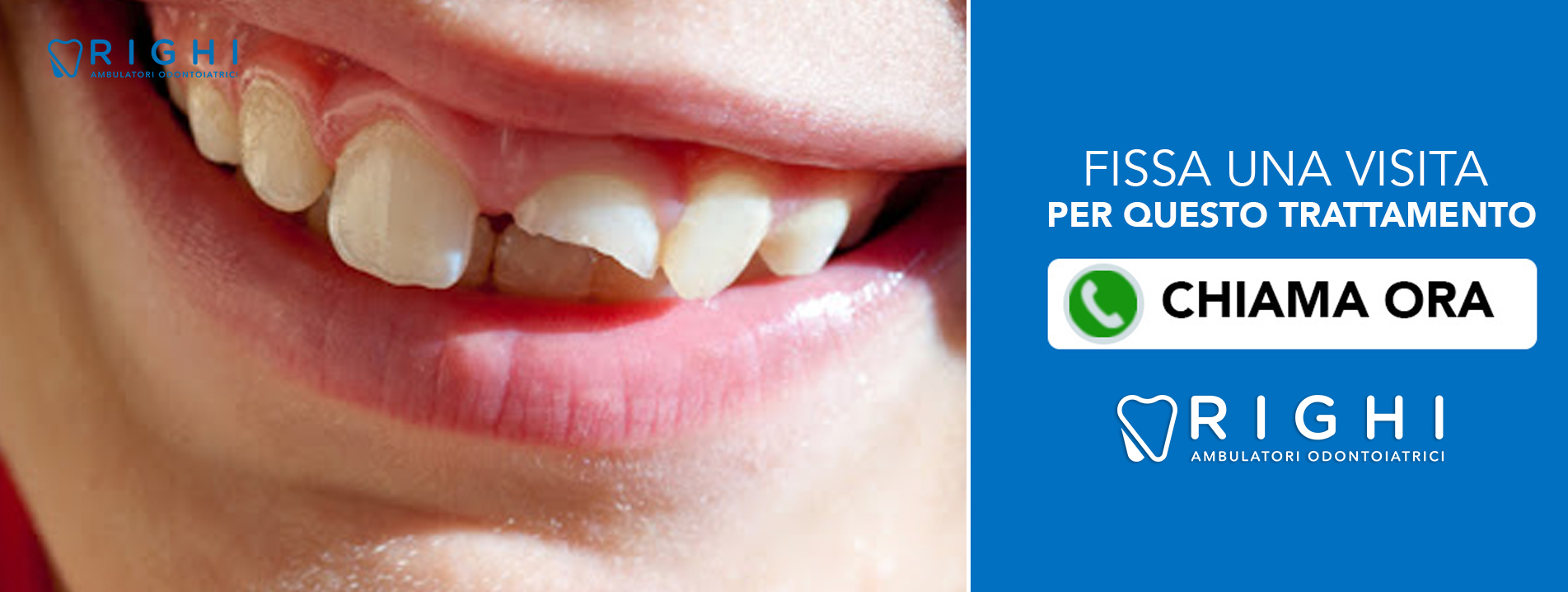 frattura-dentale-dentista-Rivalta (Reggio Emilia)